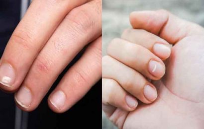 Where do white spots on nails come from?