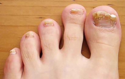 What causes thick toenails?