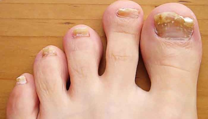 What causes thick toenails?