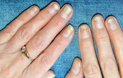 What causes nail psoriasis?