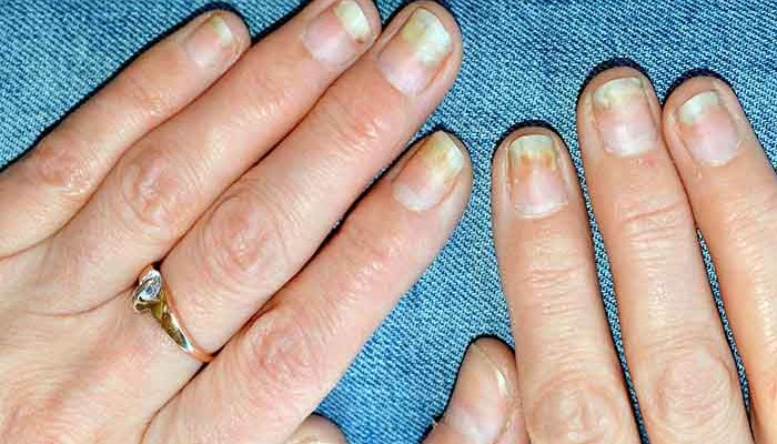 What causes nail psoriasis?