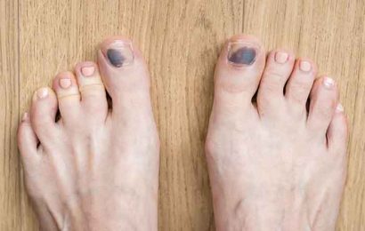 Tips to prevent black toenails