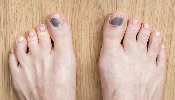 Tips to prevent black toenails