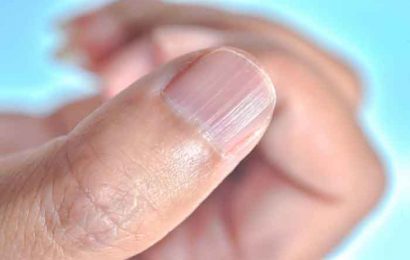 What to do when you have vertically cracked nails?